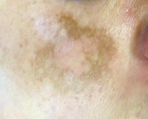 What is melasma