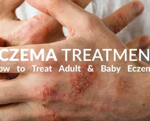 Eczema Treatment Tips for Adult and Baby Eczema