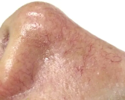 Spider veins on the face can be treated with home remedies or professional care.