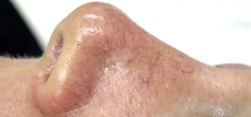 pider veins on the face can be treated with home remedies or professional care