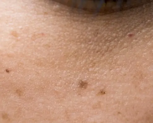 How to Remove Freckles: Different Treatments and Their Cost