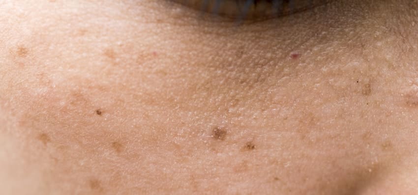 How to Remove Freckles: Different Treatments and Their Cost