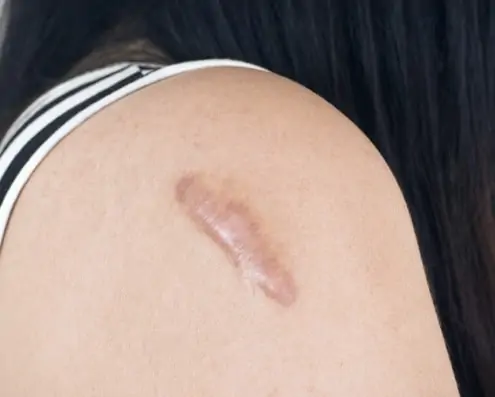 Almost everyone has experienced an injury that left a lasting scar