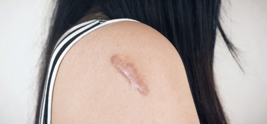girl with scar on arm header