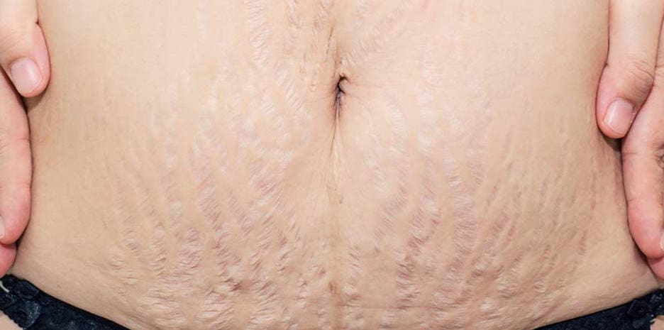 Stretch Mark Removal Treatment
