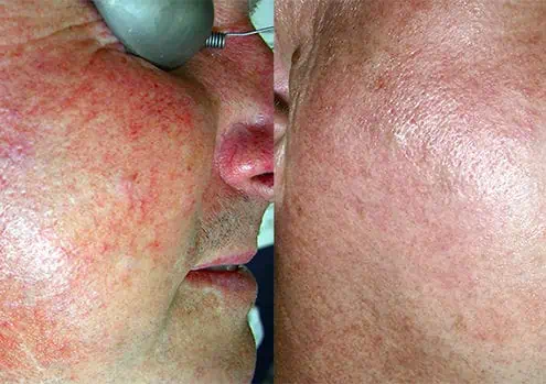 How to Get Rid of Rosacea
