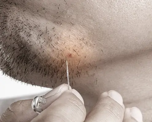 One way to remove an ingrown hair is gently lifting it with a sterile sharp object.
