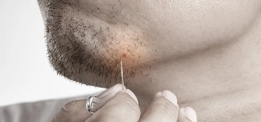 One way to remove an ingrown hair is gently lifting it with a sterile sharp object