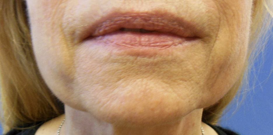 Jowls : What Causes Them and How to Get Rid of Them