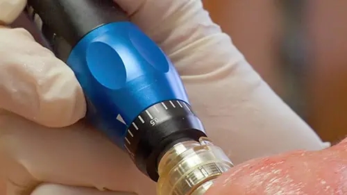 Collagen Induction Therapy, AKA Microneedling, is very effective in reducing the appearance of acne scars.
