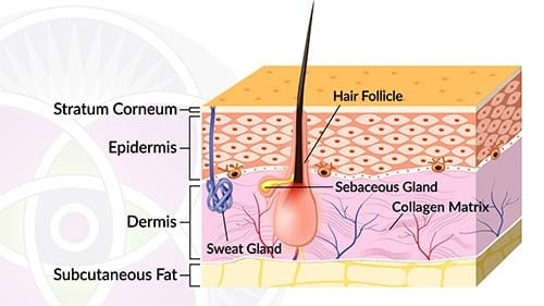 melasma skin diagram