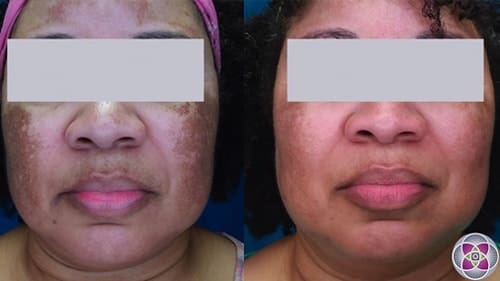 Before and after laser melasma treatment on skin type 5.