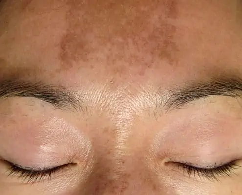 Melasma is most often caused by sun exposure and hormonal changes from pregnancy or birth control.