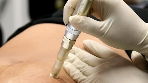 How Laser Treatment for Stretch Marks Works