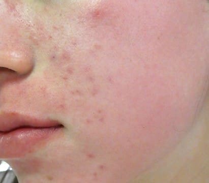 A close-up of a face showing redness, a common sign of rosacea