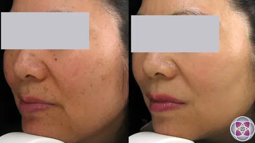 Laser targeting pigmentation and blending skin tone