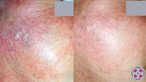 Treatment targeting spider veins, broken capillaries, and vascular birthmarks