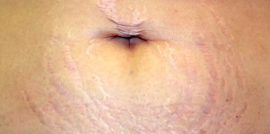 Stretch marks on the stomach often develop during pregnancy due to rapid skin stretching
