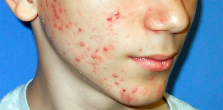 Teenage Acne – Causes, Prevention and Myths Debunked