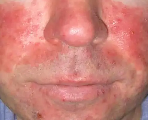 what is rosacea causes symptoms