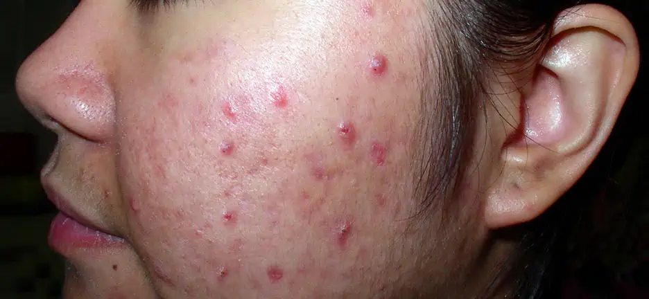 The essential science behind acne explained simply.