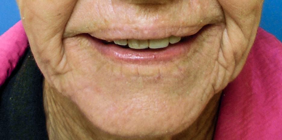 Wrinkles are a natural result of aging and sun damage