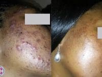 AcneBeforeAndAfter06