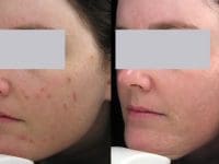 acne-laser-treatment-before-and-after-female