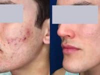 laser-cystic-acne-treatment-before-and-after-3